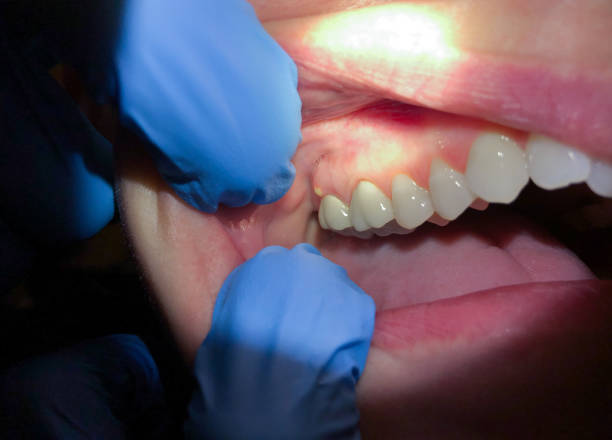 Best Emergency Dental Extractions in Ridgeville, SC